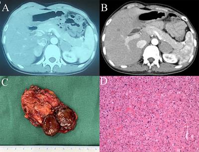 Pure androgen-secreting adrenal tumor (PASAT): A rare case report of bilateral PASATs and a systematic review